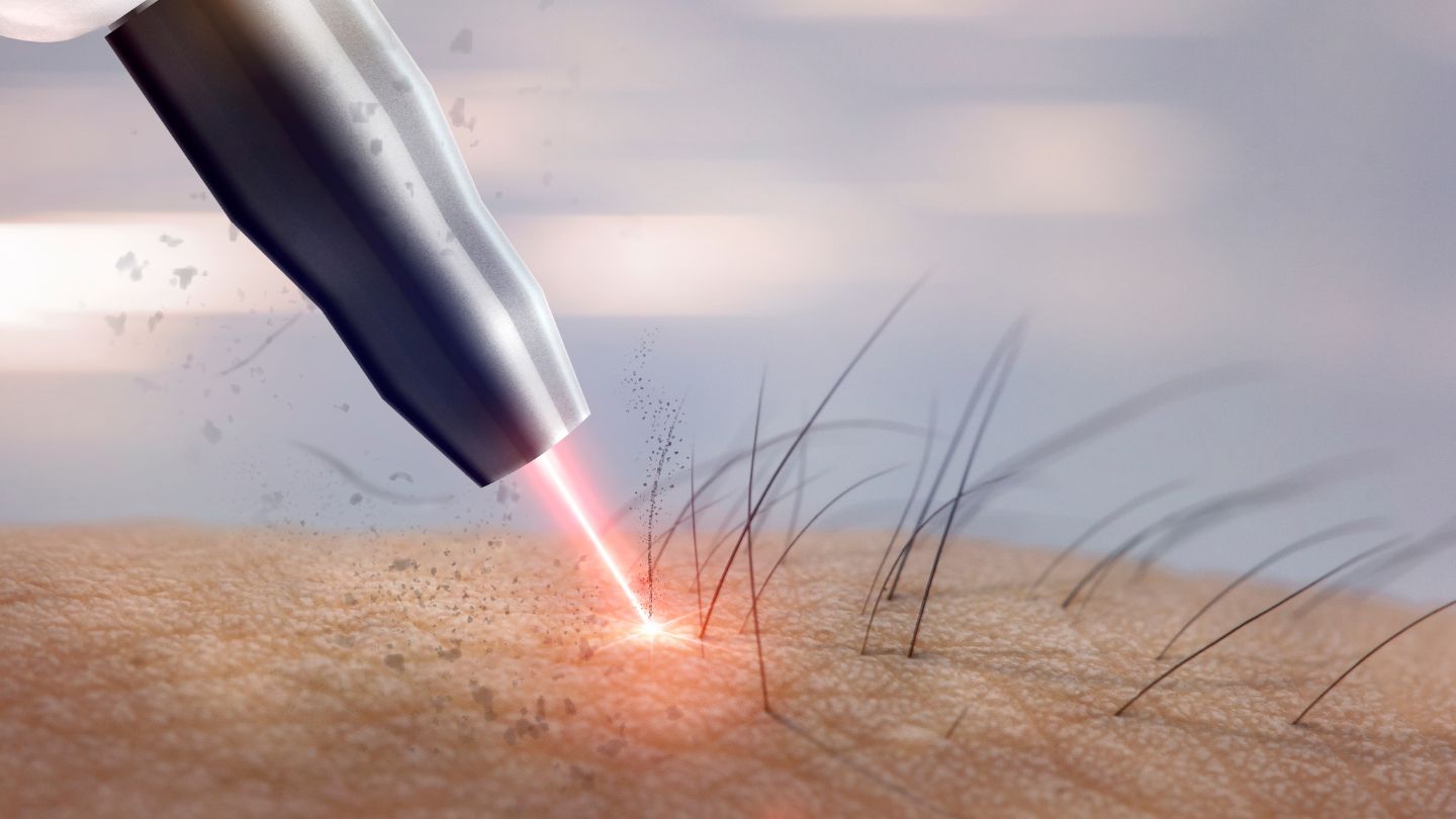 Effets secondaires du laser sur le visage : ce qu&rsquo;il faut savoir